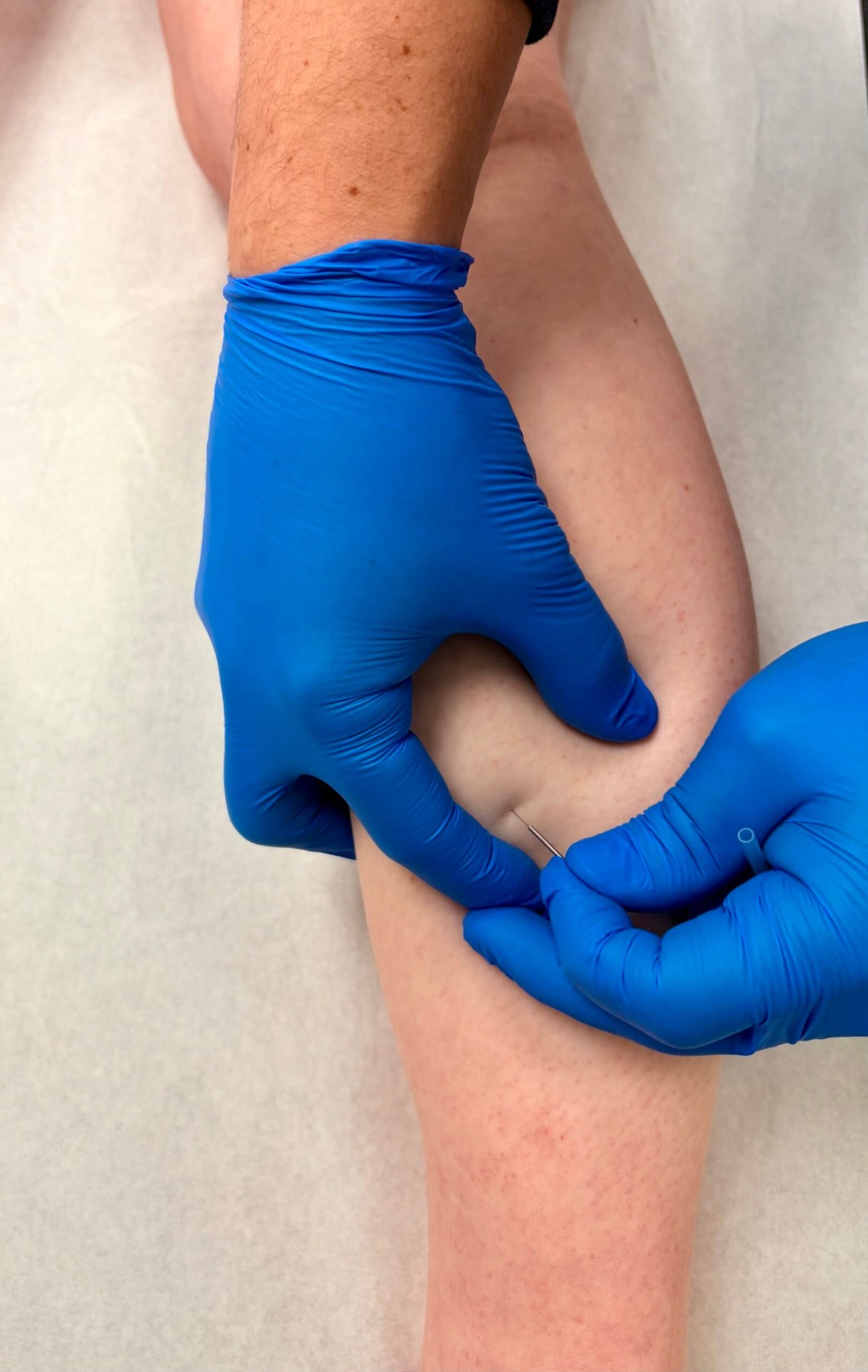 Close-up van dry needling behandeling op de knie bij triggerpoint-therapie in Eindhoven