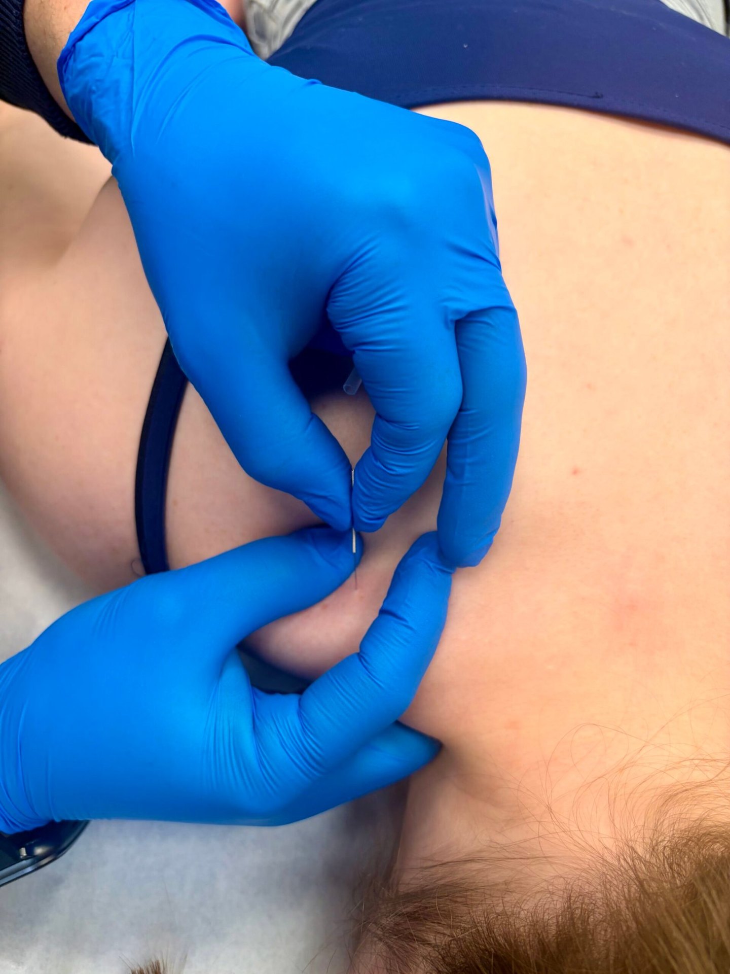 Dry needling naald wordt geplaatst in triggerpoint van de nekspier bij fysiotherapie Eindhoven